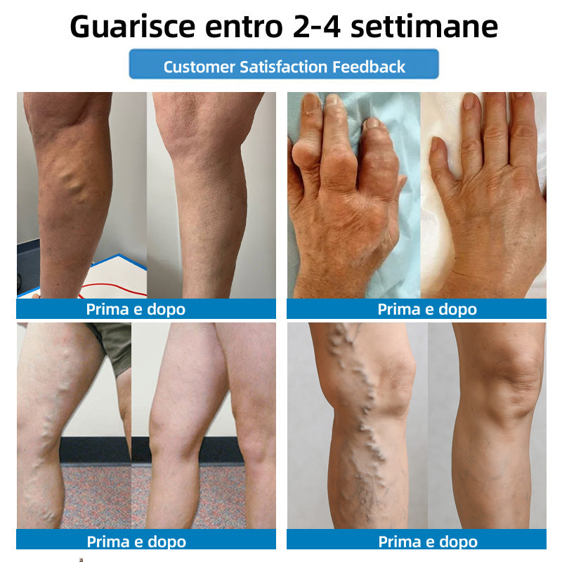 OFFERTA LIMITATA -80%｜𝐇𝐞𝐚𝐥𝐫𝐢𝐳𝐞® Cerotti Nano Microneedle 4-in-1 per Vene e Articolazioni 👍 Sollievo rapido, risultati duraturi
